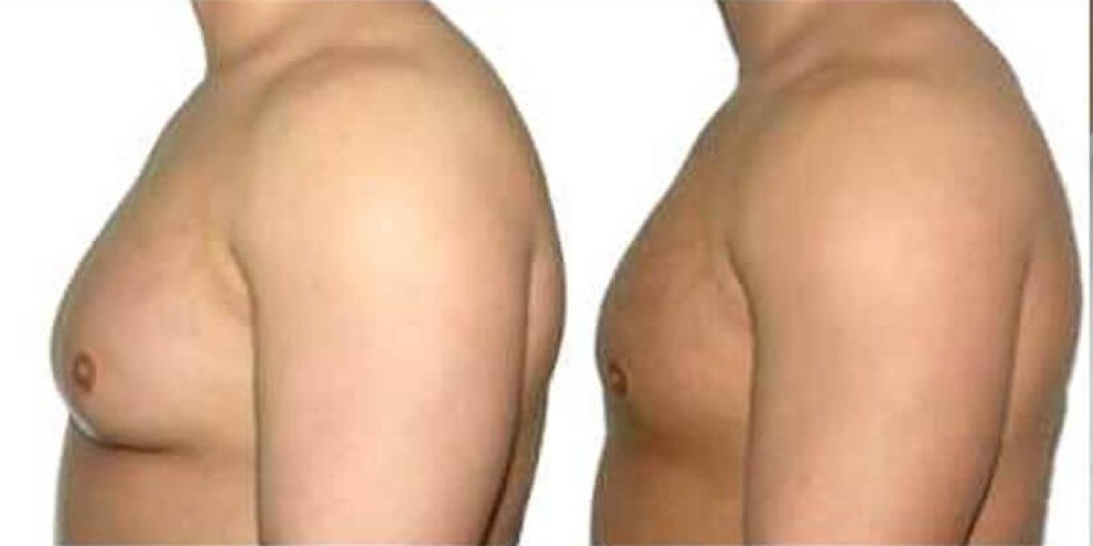 What is Gynecomastia Surgery and Why is it Needed?