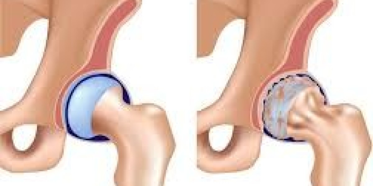 Osteoarthritis (OA) vs. Rheumatoid Arthritis (RA): Understanding the Differences and Management