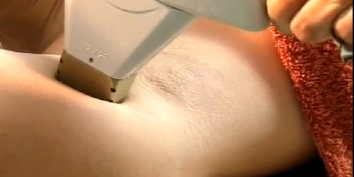 Electrolysis vs. Waxing: The Smarter Choice for Hair Removal in Dubai