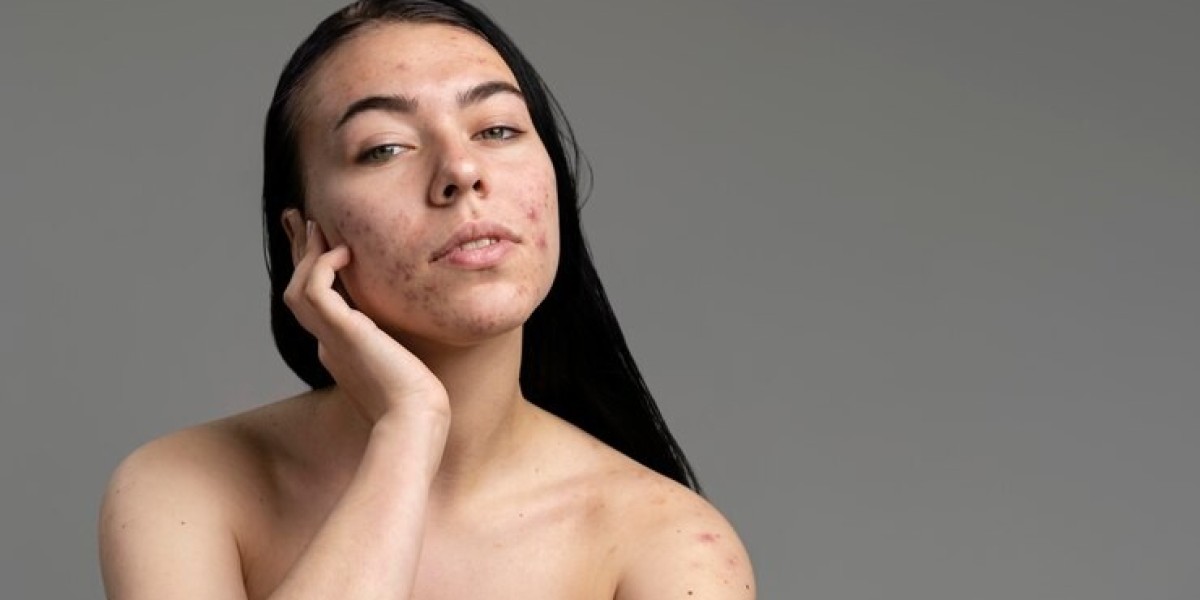 Is Acne Treatment Effective for Menopausal Skin Changes?