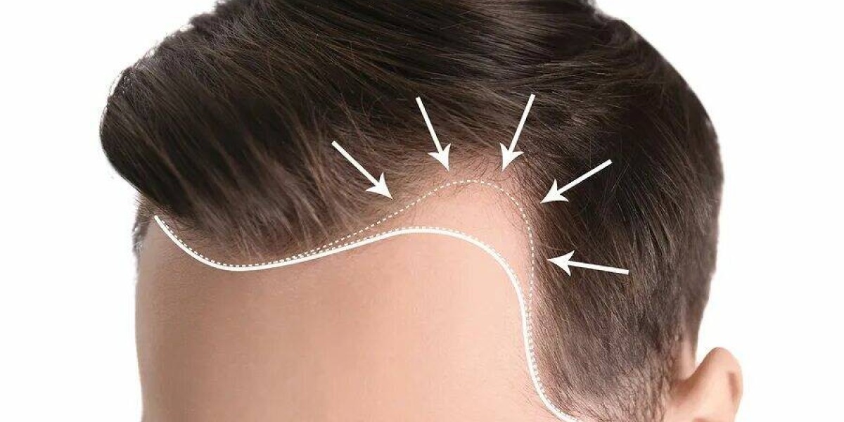 Hair Transplant Discounts and Offers in Riyadh