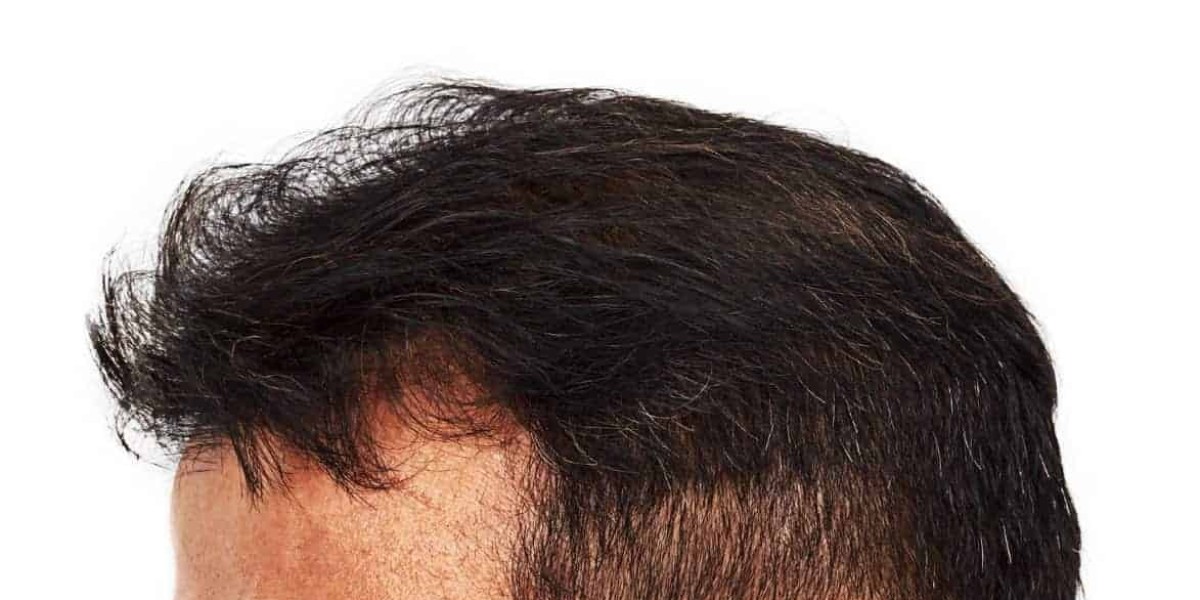 Dubai Hair Transplant Pricing: High-end vs Budget Options