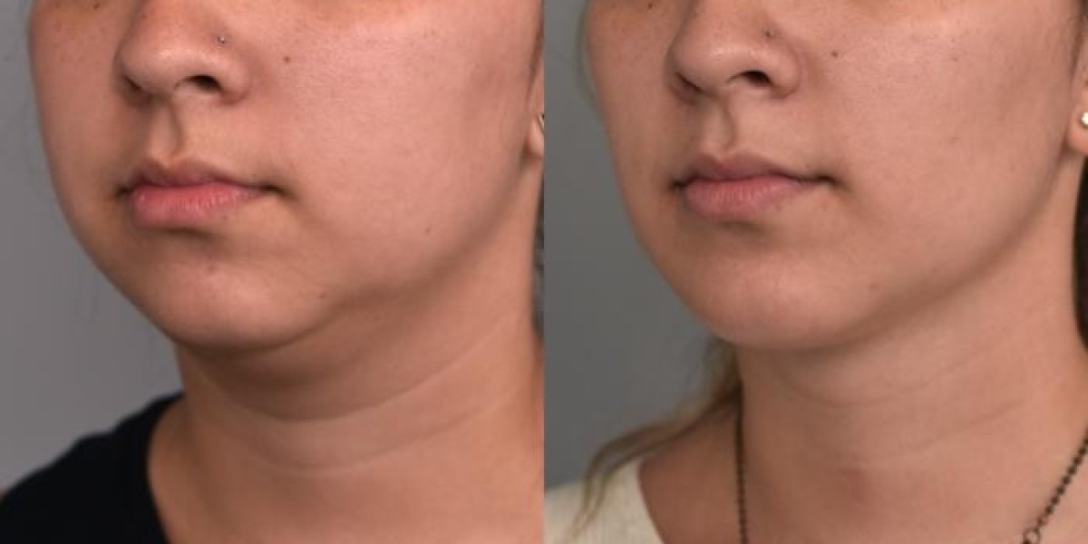 How Double Chin Liposuction Improves Neck Contours