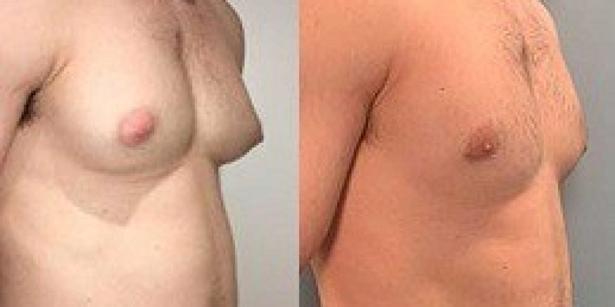 Gynecomastia Surgery A Life-Changing Solution for Men