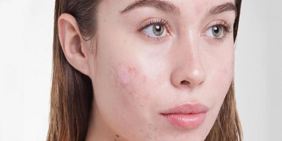 Get Rid of Acne Scars Fast: Best Treatments in Riyadh