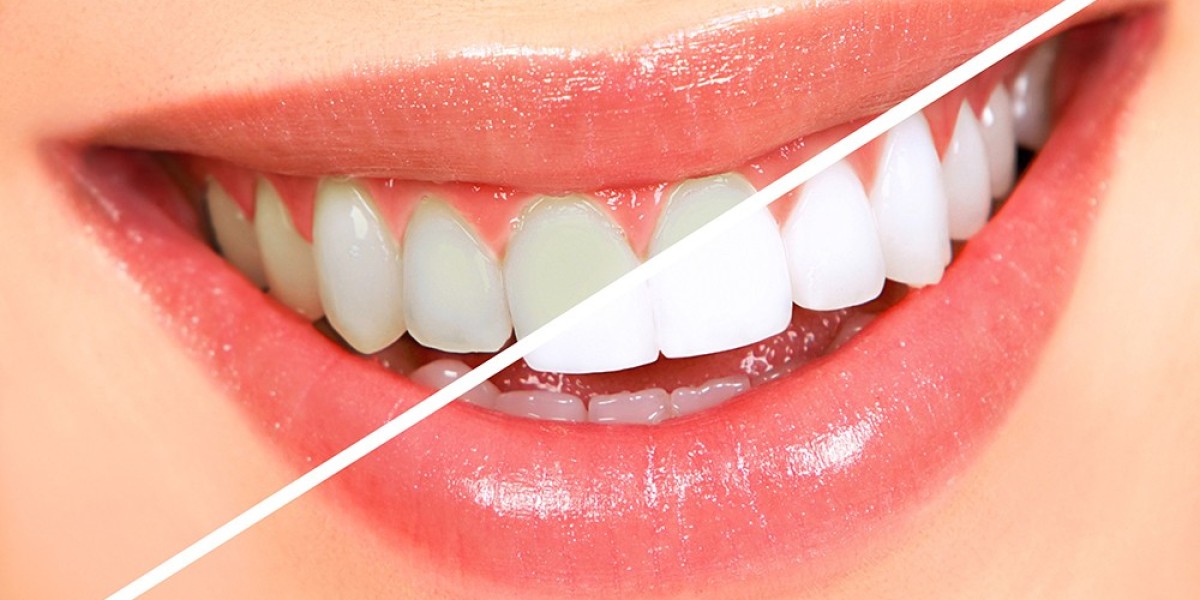 Achieve a Radiant Smile with Teeth Whitening