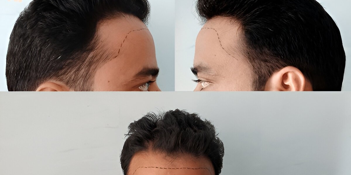 Best Hair Loss Treatment for Men: A Complete Guide