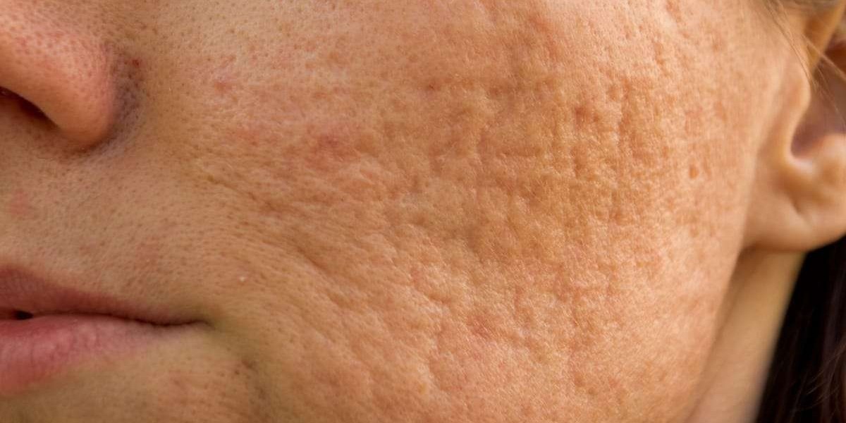 The Latest Technology for Laser Scar Removal in Riyadh