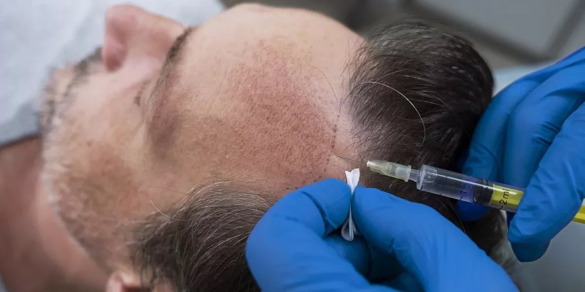 Are Hair Transplants Covered by Insurance?