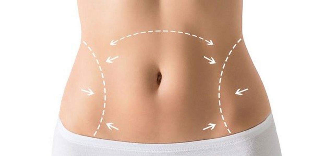 Tummy Tuck Financing Options in Riyadh: Affordable Payment Plans