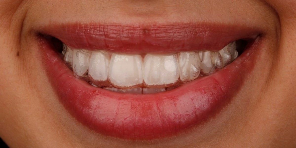 Invisalign Braces Cost: What Are You Really Paying For?
