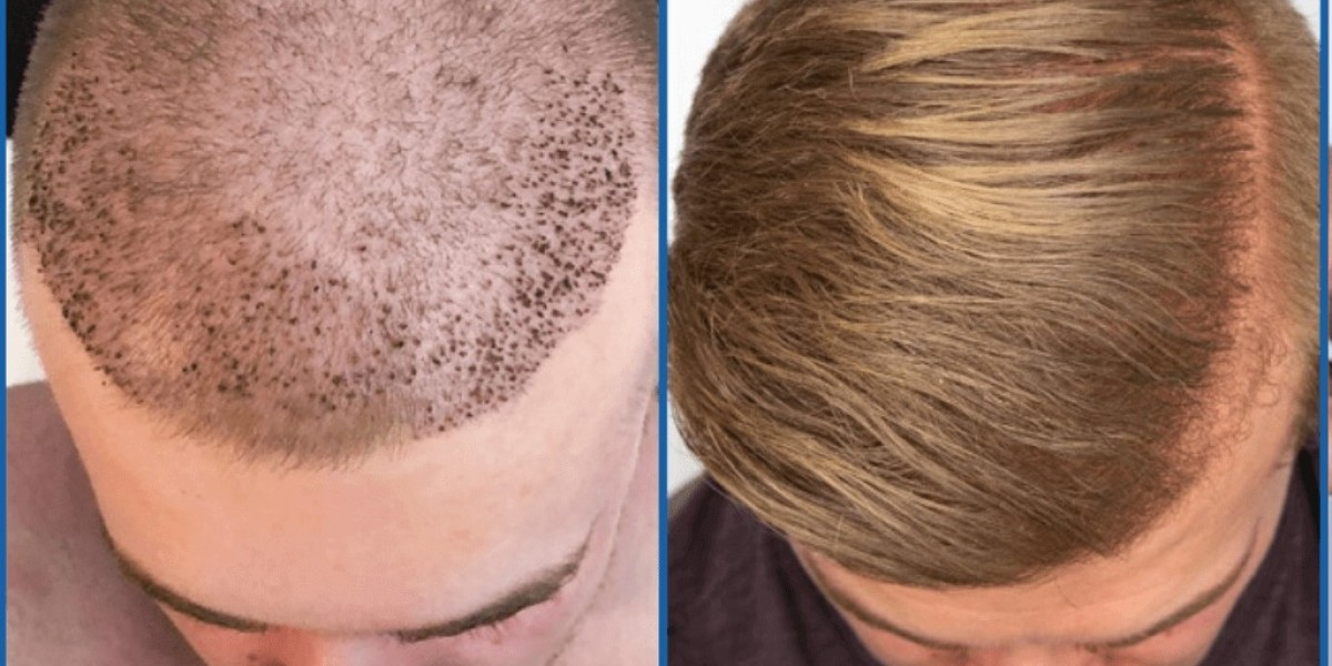 Hair Restoration Market Competitor Strategies: Key Approaches to Dominating the Industry in 2025 and Beyond