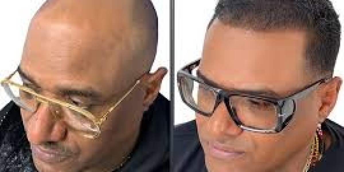 Afro Hair Transplant for Men: What to Expect and How It Works