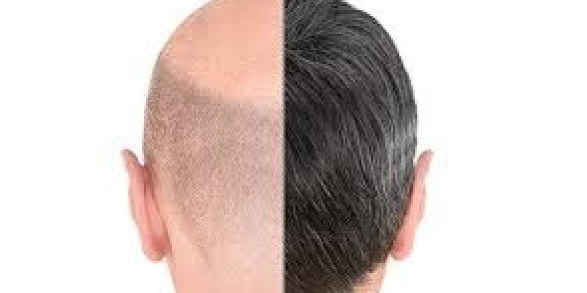 Is Hair Transplant in Dubai Worth It? Experts Weigh In