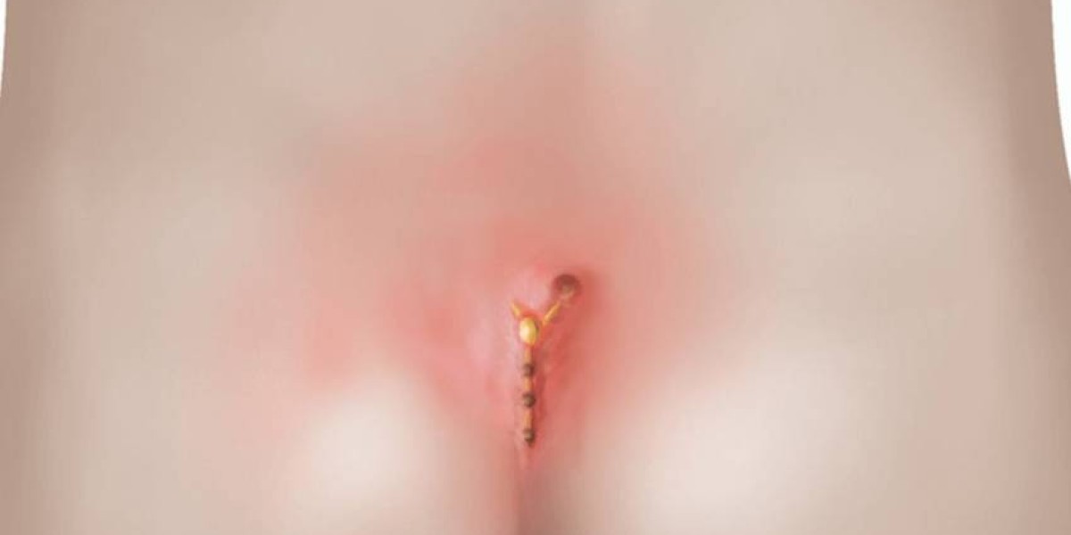 Pilonidal Sinus Treatment: How Laser Therapy Can Help?