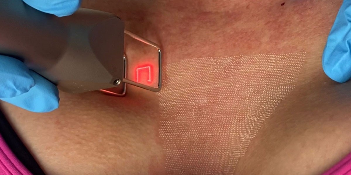 How to Get the Best Results for the Best Price with Fractional CO2 Laser Treatment