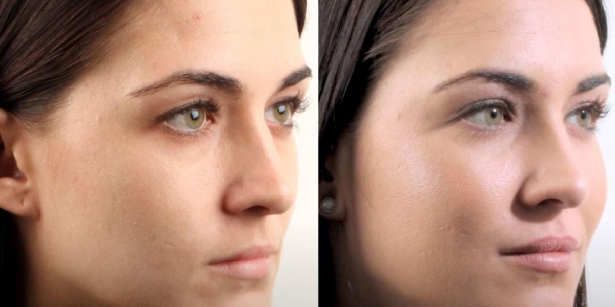 The Best Cheek Filler Brands Available in Riyadh
