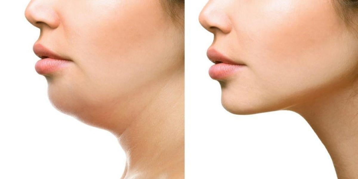 Radiofrequency Double Chin Reduction in Riyadh