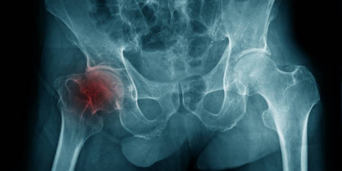 Avascular Necrosis Market Growth, Share, Past Research, Deep Analysis and Present Data 2024-2032