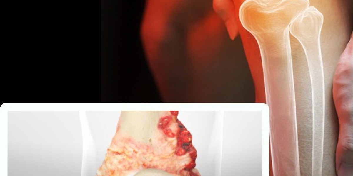 Reliable Bone Cancer Treatment in Lahore – Specialized Care at Ortho Center