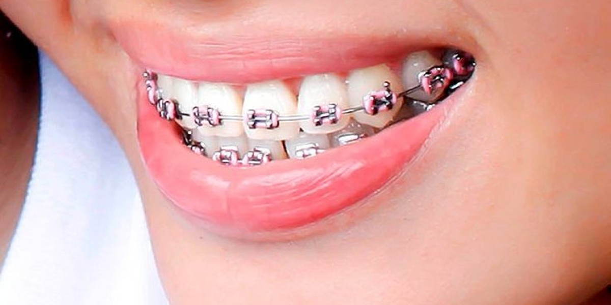 7 Common Misconceptions About Orthodontics in Riyadh