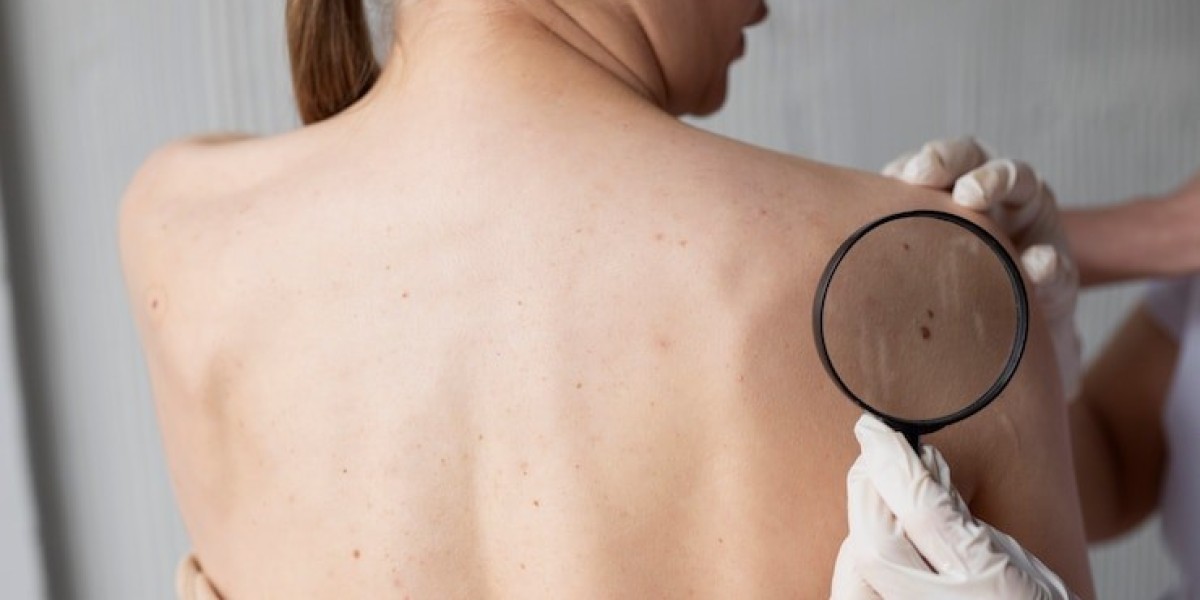 Are Skin Tags Dangerous to Your Health?