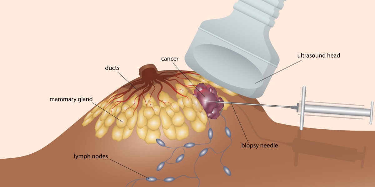 Biopsy for Diagnostic Purposes: Understanding the Process