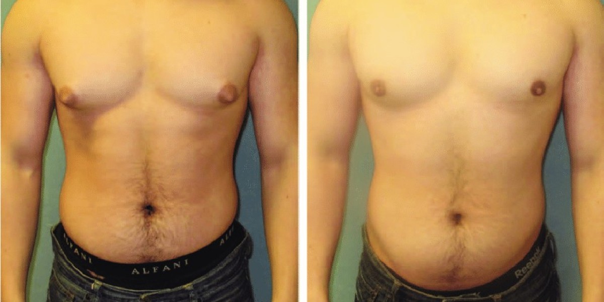 Gynecomastia Surgery in Dubai: A Life-Changing Solution for Men