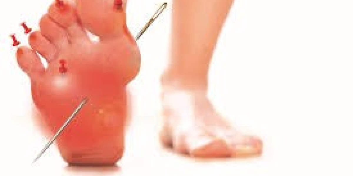 The Role of Physical Therapy in Neuropathic Pain Management