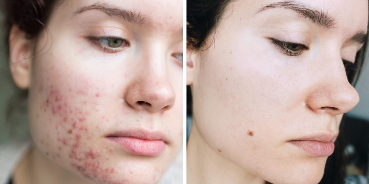 Natural & Medical Solutions for Pimples in Riyadh