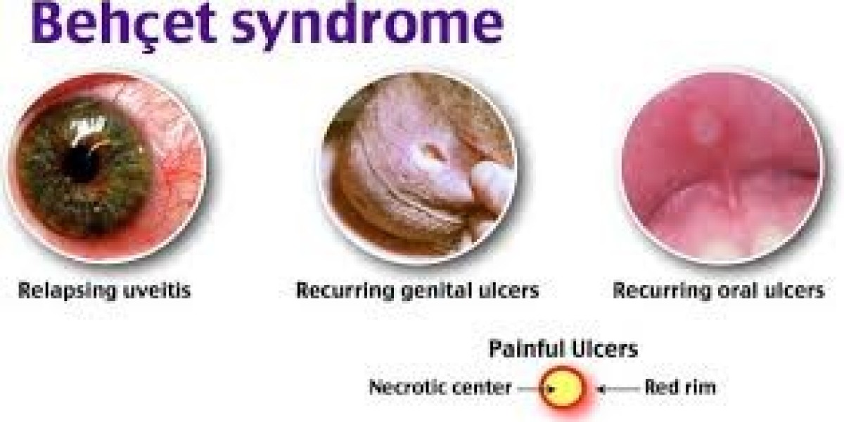 Steady Growth Ahead: Behcet’s Syndrome Market Forecast to Reach $30.5 Million by 2030