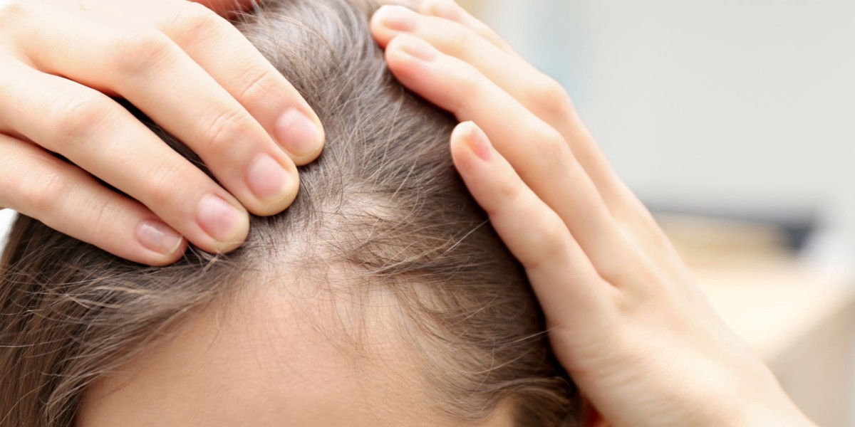 How to Handle Initial Shedding on Finasteride for Hair Loss?