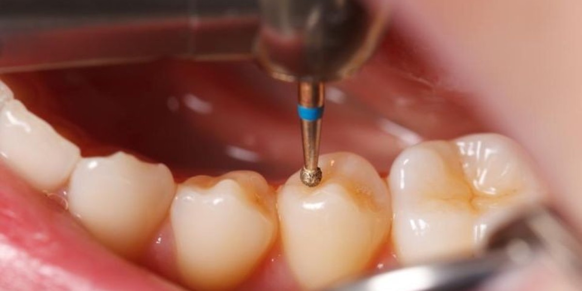 The Role of Dental Filling Treatment in Riyadh in Oral Health