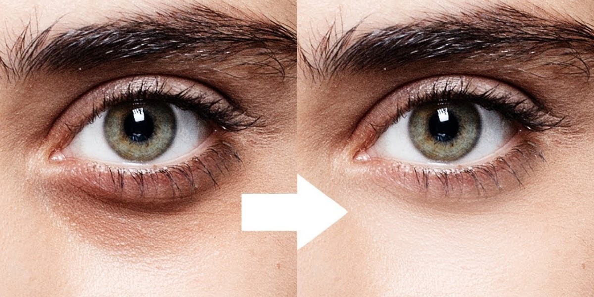 Mesotherapy for dark circles in Riyadh