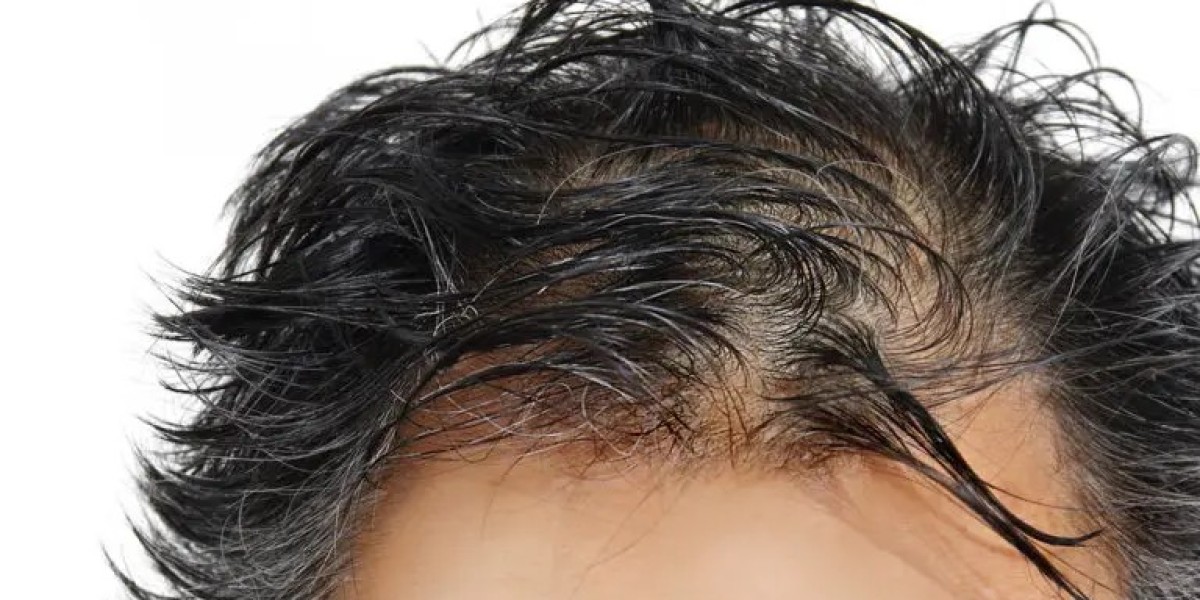 The Best Hair Replacement Clinic in Dubai