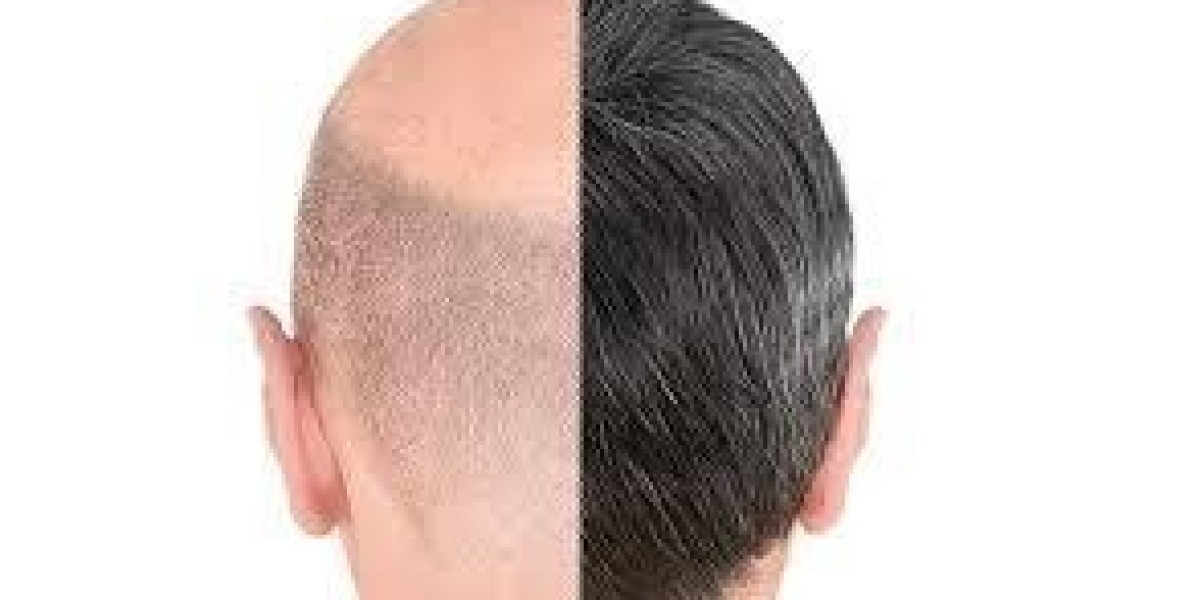 ?‍♂️✨ خطوات العناية اليومية بعد زراعة الشعر: دليل شامل لضمان أفضل النتائج ??️