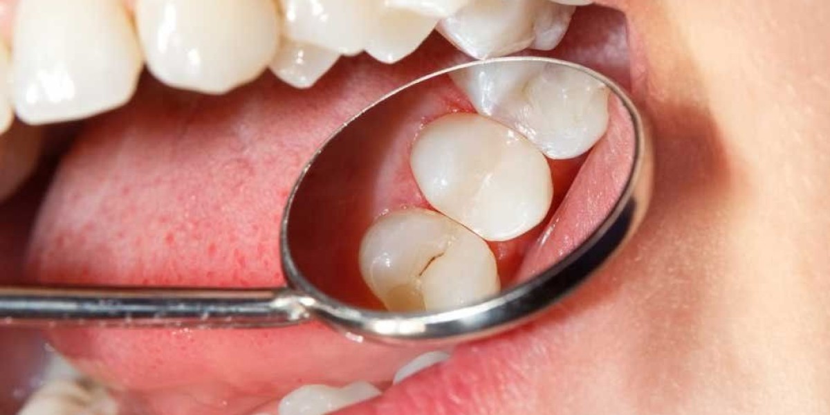 Nhổ răng hàm trên có nguy hiểm không? Giải đáp từ chuyên gia