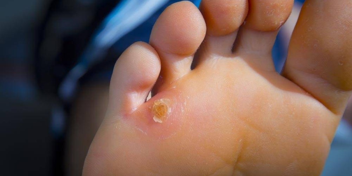 How Much Should You Spend on Skin Wart Removal?