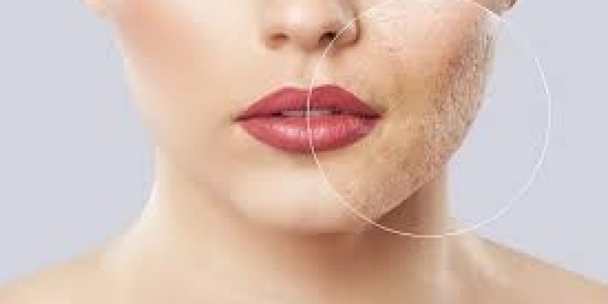 Get Dermal Fillers in Dubai – Smooth Wrinkles Instantly