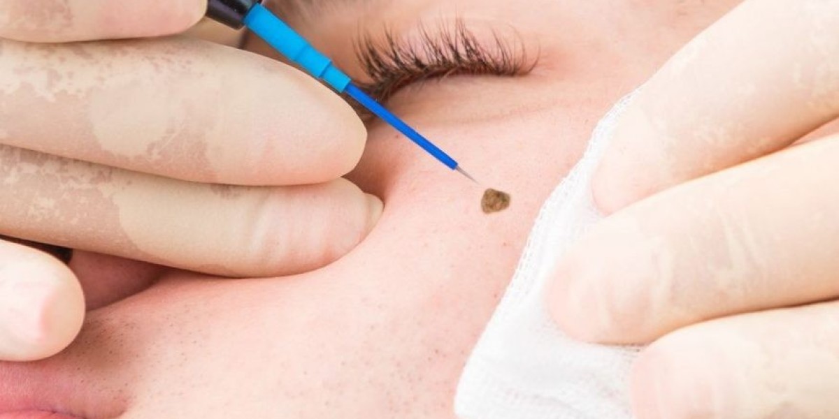 How Long Does It Take to Heal After Mole Removal?