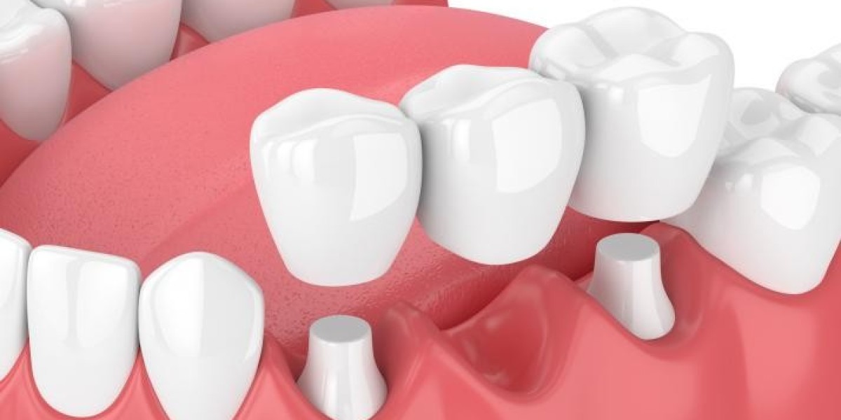Common Problems with Dental Crowns and How to Fix Them