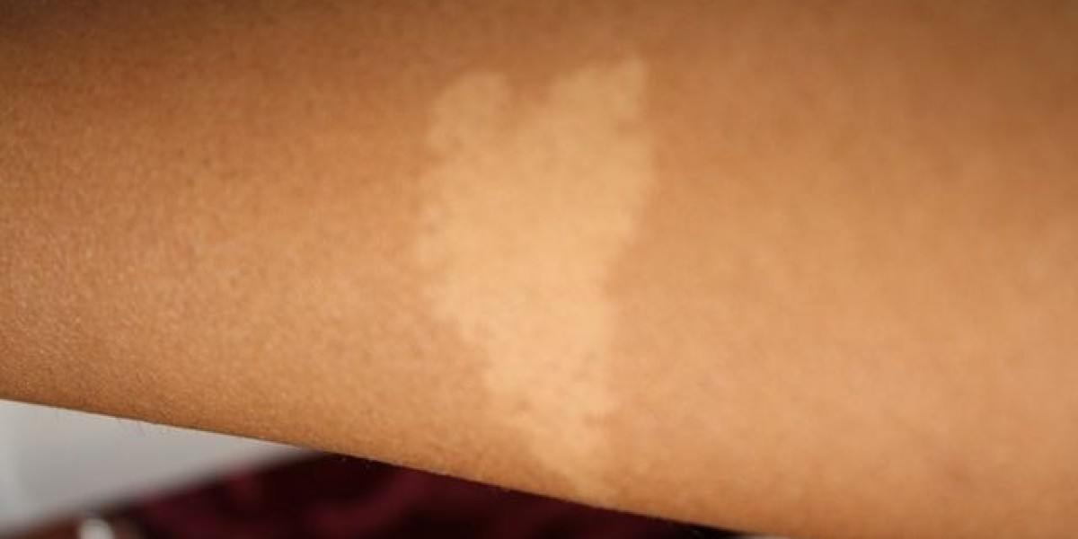 What to Expect After Birthmark Removal in Riyadh