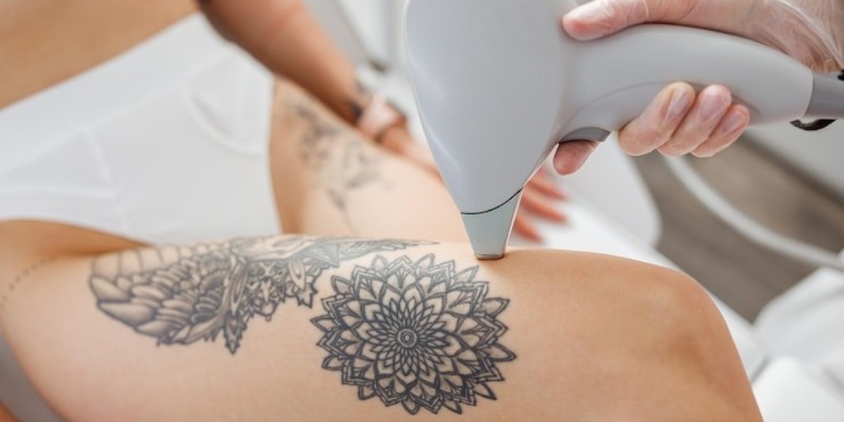 How does laser tattoo removal work?
