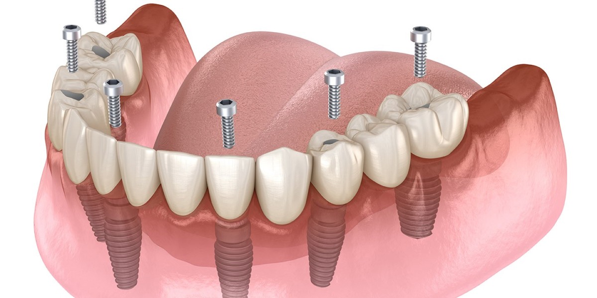 Is Dental Implants Effective for Multiple Teeth?