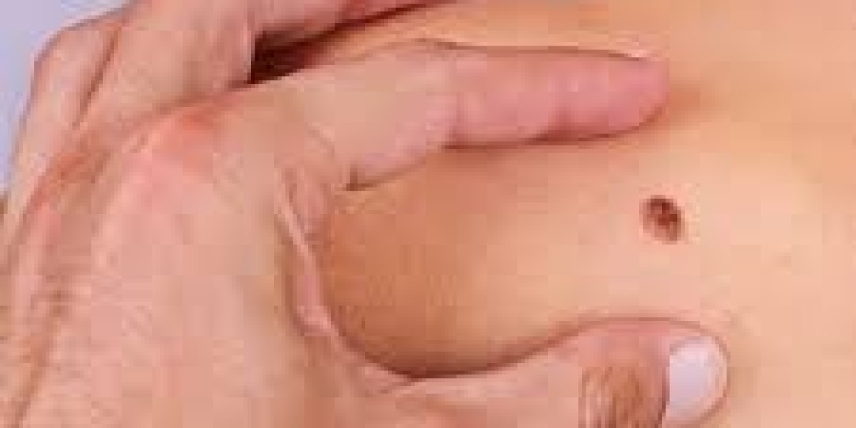 Wart-Free Skin: Exploring the Best Removal Options in Dubai