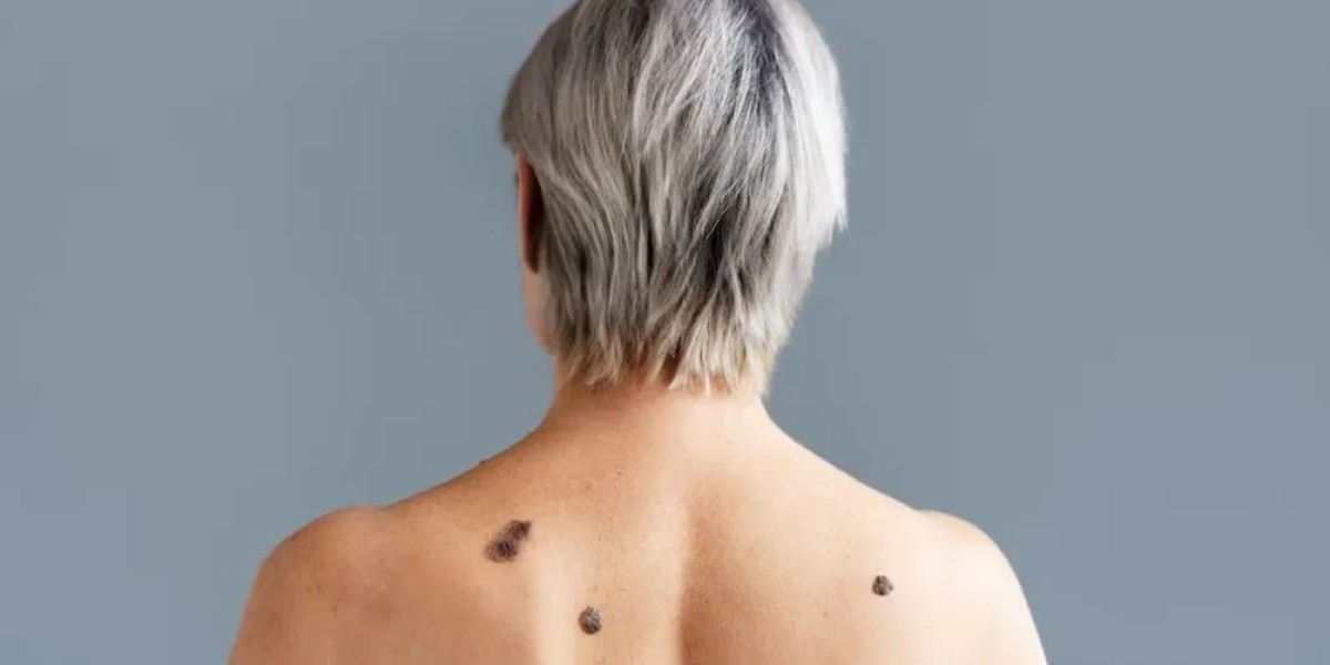 Save Your Skin: Wart Removal Costs Explained