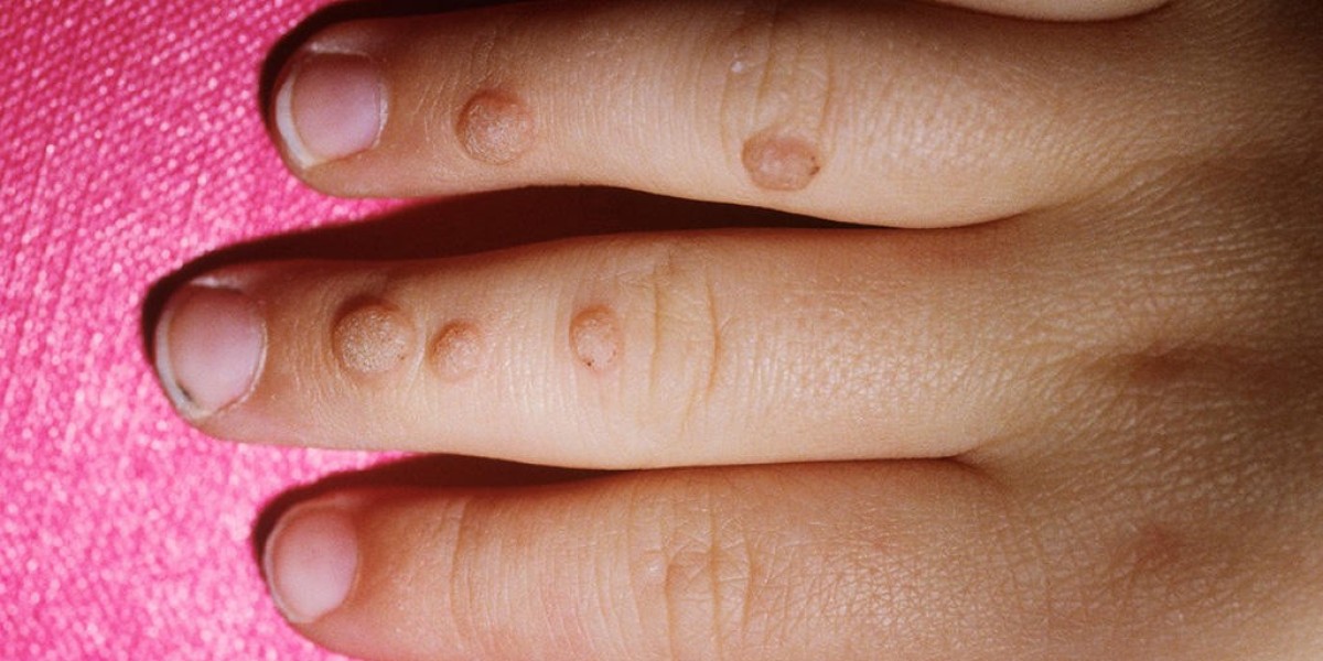 How to Pay for Skin Wart Removal: Financial Tips and Advice