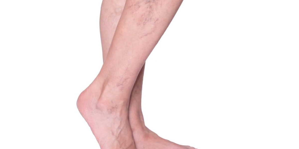 The Cost of Varicose Veins Treatment in Riyadh