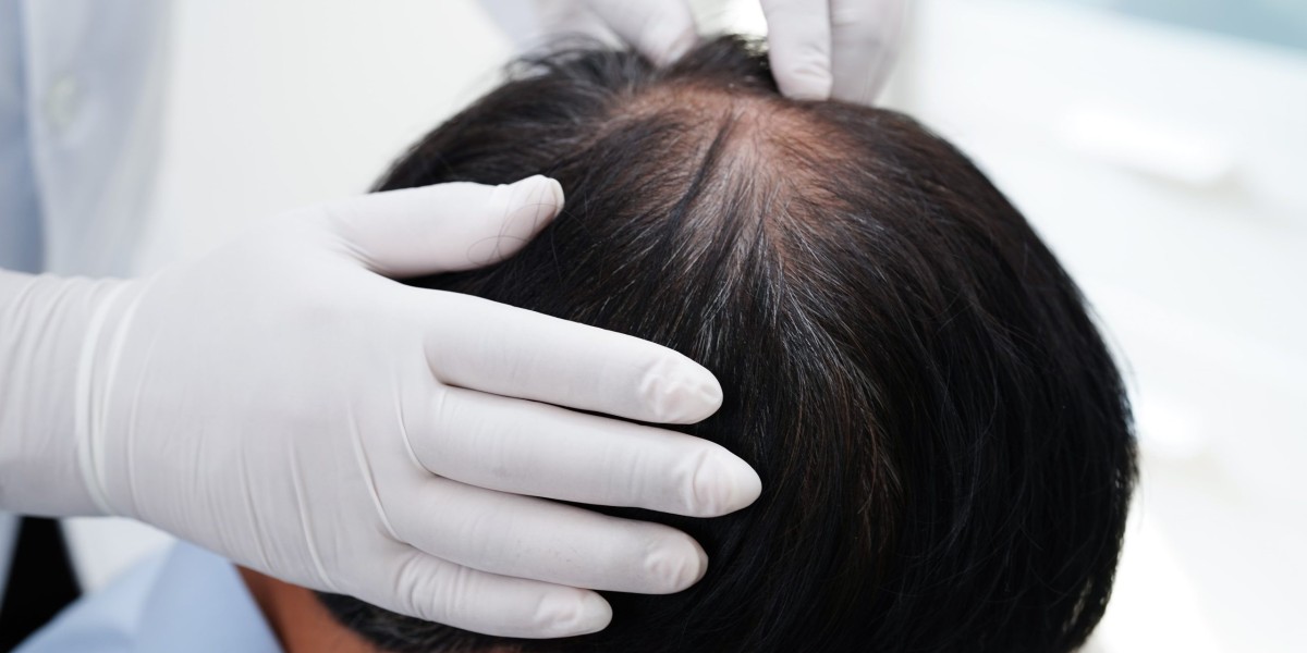 feel cofidently with hair Transplant in peshawar