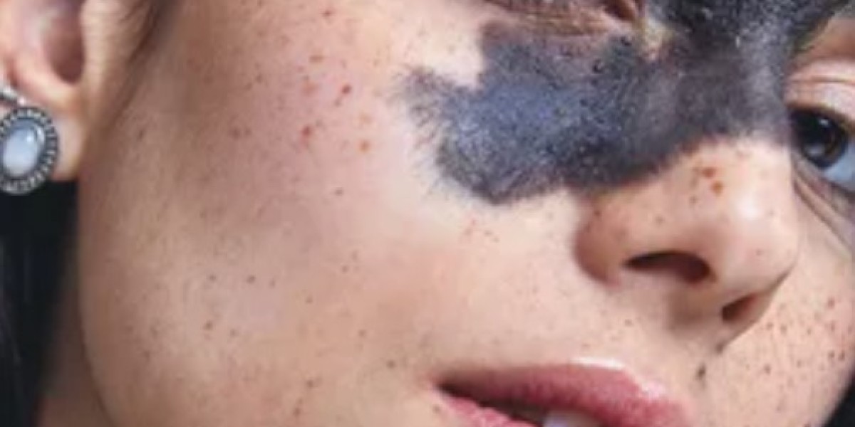Best Cosmetic Clinics for Birthmark Removal in Riyadh